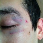 The shiner didn't look too bad
