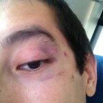 It was painful, but I'm a man :)