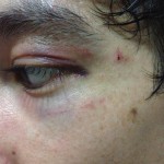The bruising and swelling came up nicely!