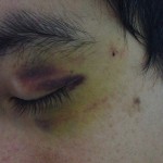 A nice black eye!